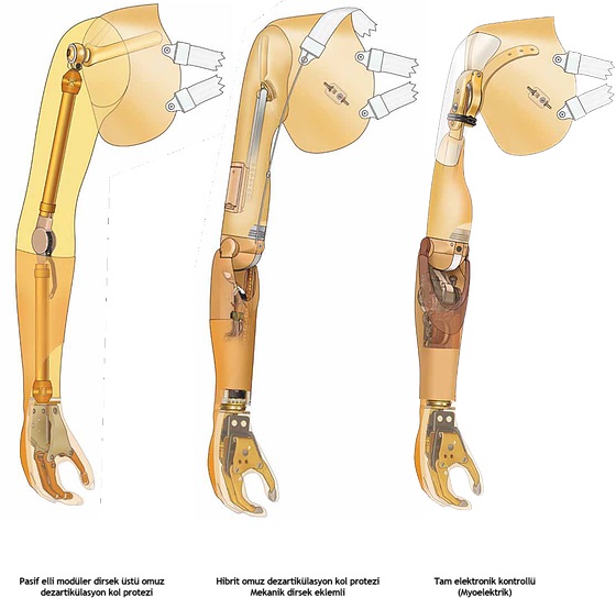 Omuz Dezertikülasyonu Protezleri