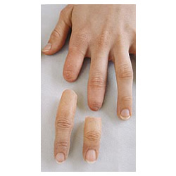 Parmak ve Parsiyel El Protezleri