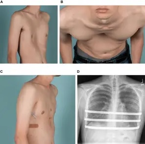 Pektus-Ekskavatum-karinatum-2