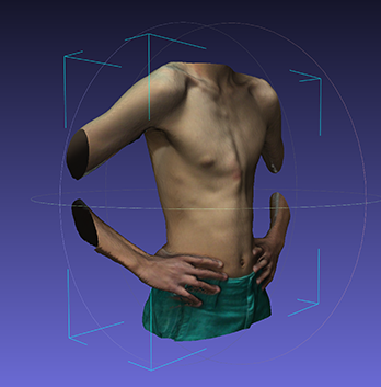 Pektus-Ekskavatum-karinatum-4