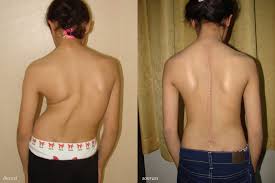 cocuklarda-omurga-egriligi-3