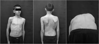 cocuklarda-omurga-egriligi-4