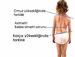 cocuklarda-omurga-egriligi-7