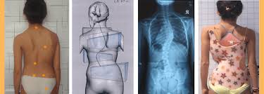 cocuklarda-omurga-egriligi-skolyoz-patolojisi